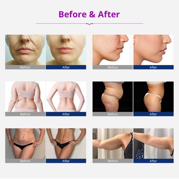 Жирная потеря 5 в 1 приборе ультразвукового тела вакуума 40K RF машины кавитации тонком