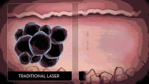 Adjustable Picosecond Laser Tattoo Removal Architectured Arm Spot Size1 - 10mm