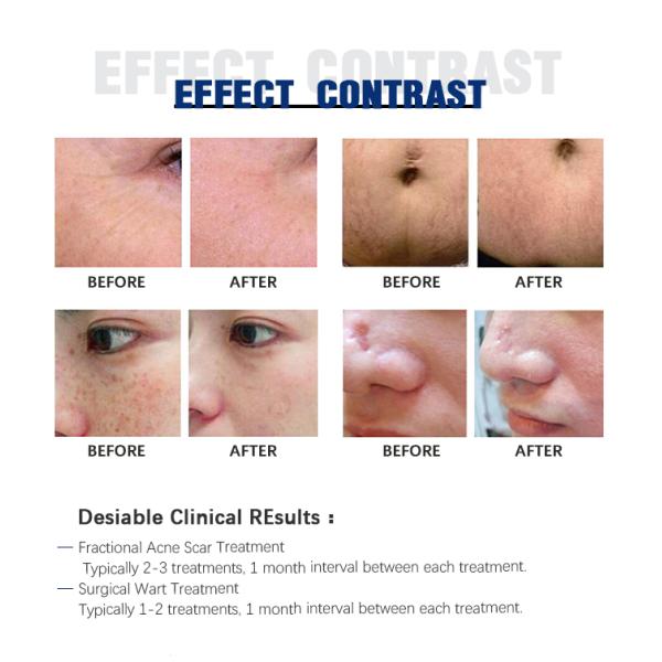 Air Cooling CO2 Fractional Laser Machine Scar Removal Stretch Mark Removal