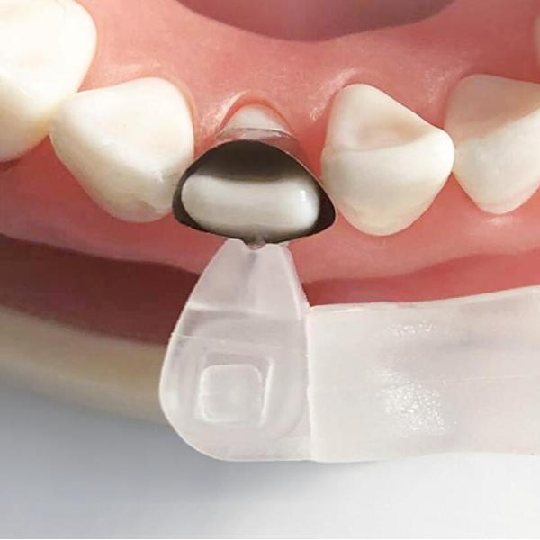 Universal Matrix Band Retainer M5 2.0