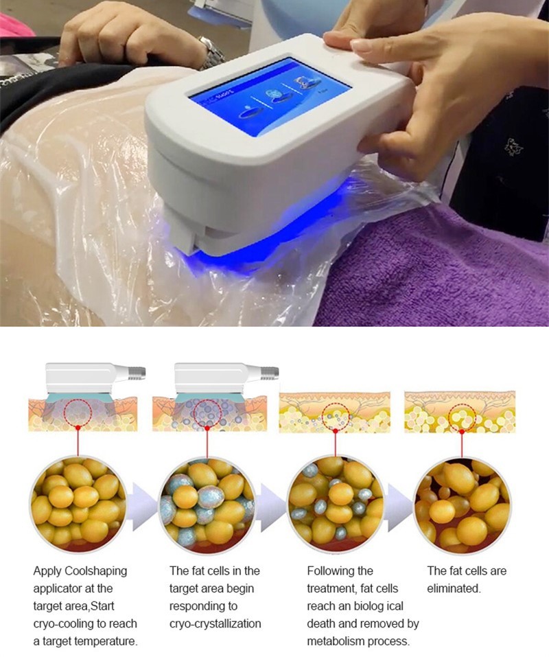 10,4» углов 360 окружая замораживание Cryolipolysis жирное уменьшая машину для жирного удаления