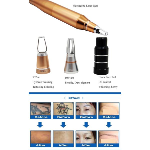 OEM Q Switch Commercial Tattoo Removal Machine White Color ND Yag Laser