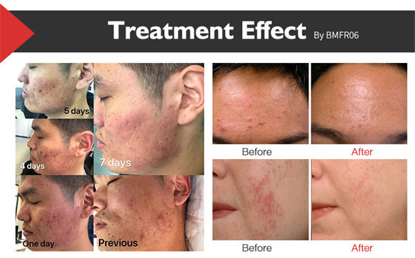 110V к лазеру СО2 машины удаления пигмента 250V 10600nm частичному