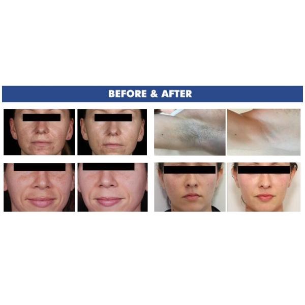 IPL SHR Hair Removal Machine / Elight Hair Removal Machine Medical CE FDA Approved