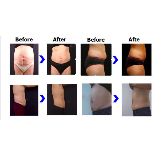 BTL Vanquish Me Body Shaping System Slimming / ME Abdomen Fat Loss Machine