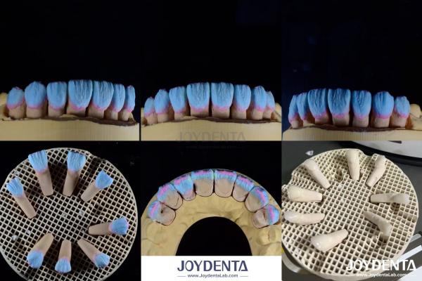 High Biocompatibility Feldspathic Ceramic Veneer Glossy For Dental Restorations