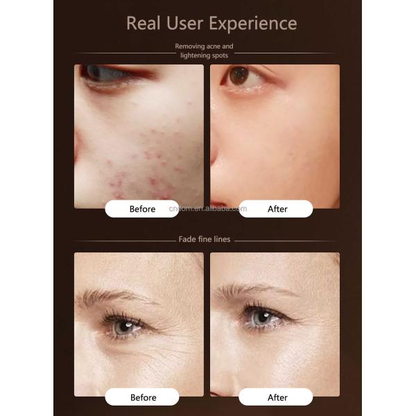 Compact Skin Led Facial Light Therapy for Acne Improvement Professional Grade