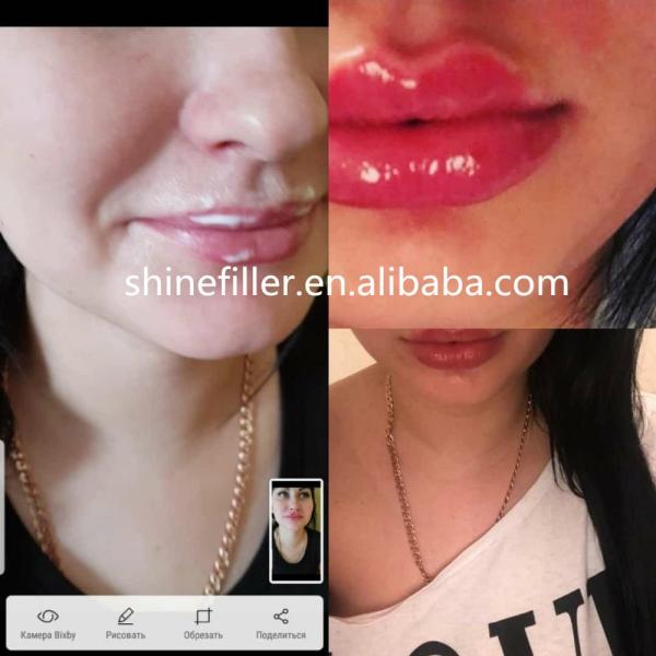 Aboutez le regard naturel des injections 20ml de remplisseur d'acide hyaluronique d'amélioration