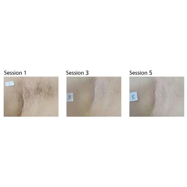 Painless Ice Laser Hair Removal Machine  755nm 808nm 1064nm With Speed Diode Handpiece