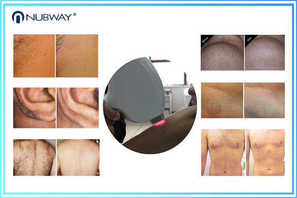 Medical laser manufacturer germany 20*12 big spot 808nm Diode Laser hair Removal