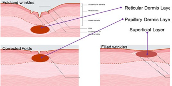 Best price Fractional Rf Wrinkle Removal  Face Lift, Skin Rejuvenation, Wrinkle Remover, ScMicroneedle quipment for sale