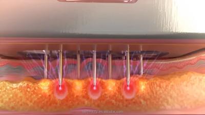 Máquina de Microneedling de RF fracionada segura e precisa para rejuvenescimento e aperto da pele
