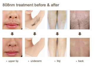 Painless Permanent Hair Removal 808nm Diode Laser Hair Removal Machine White Color