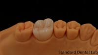 Noritake Porcelaine de contour complet couronne de zirconium personnalisée Vita Shade pour la restauration dentaire numérique esthétique par le laboratoire dentaire