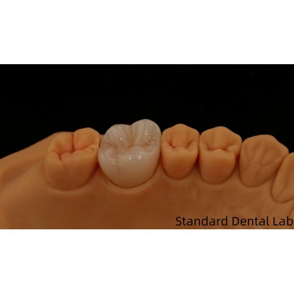 Noritake Porcelain Full Contour Zirconia Crown Customized Vita Shade for Esthetic Digital Dental Restoration by Dental Lab