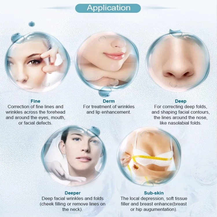 Впрыски дермального заполнителя Juvederm 2ml губы Hyaluronic кисловочные
