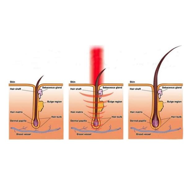 Hair Loss Treatment 808nm 90Hz Laser Hair Regrowth Machine