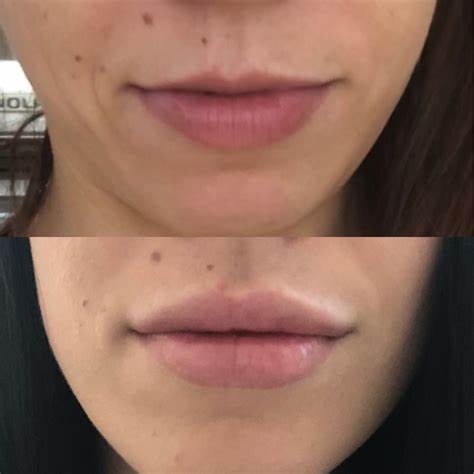 Впрыска заполнителя Ultra3 Ultra4 Juvederm Voluma дермальная для глубоких морщинок