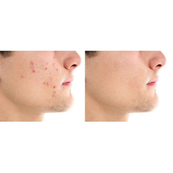 Ультразвуковое устройство для красоты ЛДМ Аллергия на кожу и оборудование для красоты тела