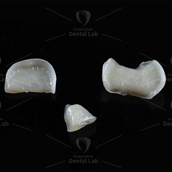 Natural Composite Inlays And Onlays Ceramic Crown Dental Inlay Onlay Biocompatibility