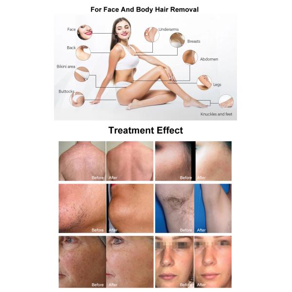 OEM Hair Remove Device Diode Laser 755 808 940 1064nm Beauty Salon Equipment Hair Removal Laser Machine Beauty Center