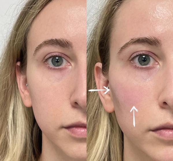 Skinject Deep Hyaluronic Acid Dermal 2ml Lips Fillers Injectable