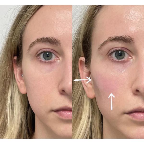 заполнитель 1ml Juvederm дермальный для стороны губы извлекая морщинки Skinject Allergan
