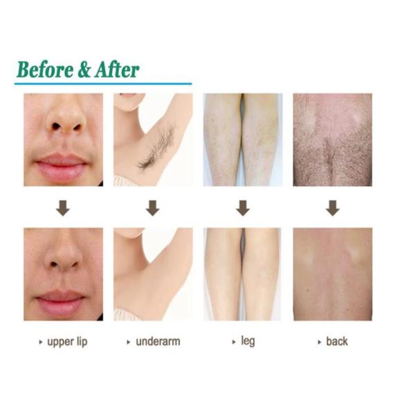 Аппаратура подмолаживания кожи льда красоты 808 машины удаления волос лазера диода тела