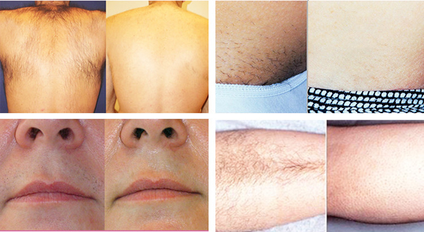 Approved CE 808nm diode laser  painless permanent 808nm laser hair removal machine