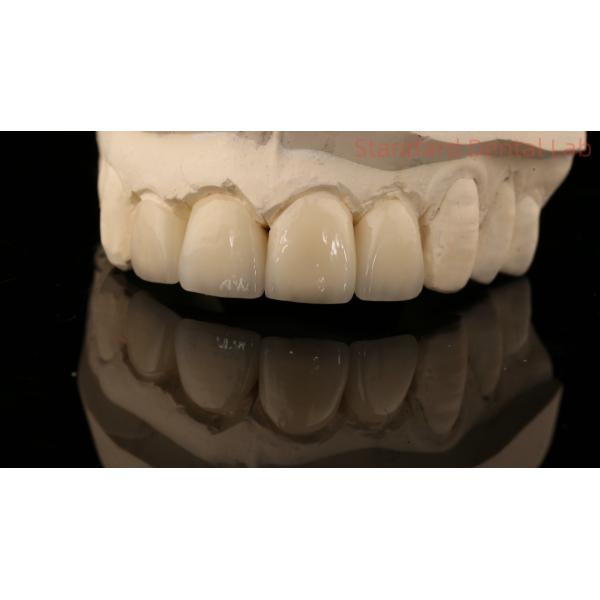 Strong Layered Zirconia Crown And Bridge In Good Esthetics Zirconia Layered China Dental Lab