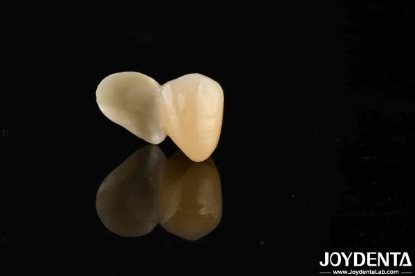 Emax Maryland Veneer Clinical Bonding Adhesion For Color Matching Dental Repair