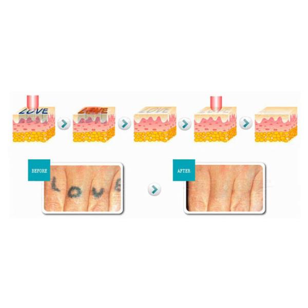 Long Pulsed Nd Yag Laser Tattoo Removal Machine ,  Clinic Tattoo Eraser Machine