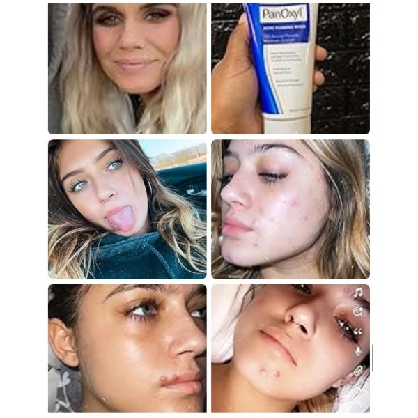 Antimicrobiano Peróxido de benzoilo Acné espumante Limpieza facial sin olor