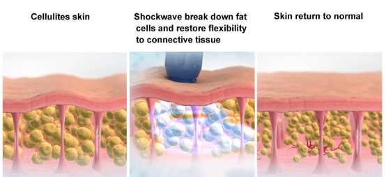 Терапия ударной волны машины обработки целлюлита уменьшая машину