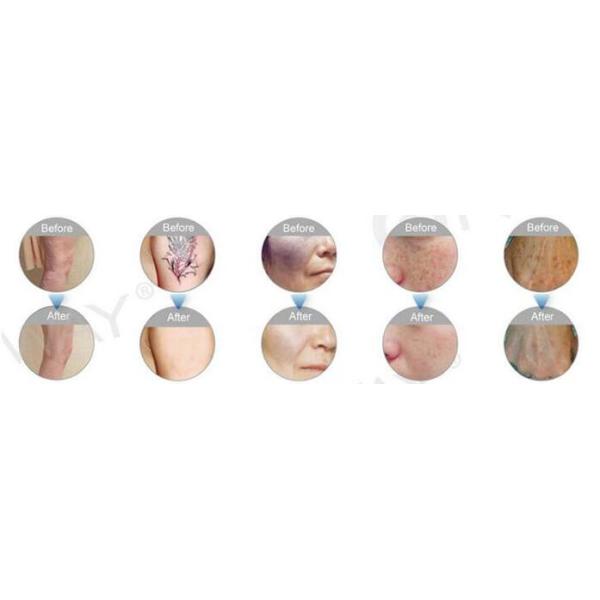 Newest innovative product high quality laser tattoo removal machine