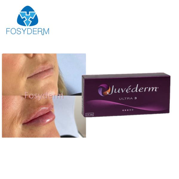 Enchimento cutâneo ácido hialurónico 2x1.0ml do realce do bordo de Juvederm Ultra3