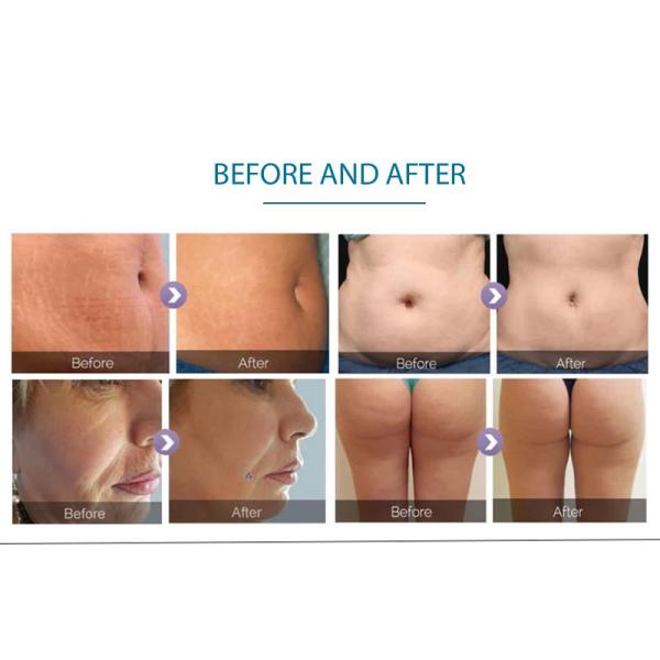 Velaslim Infrared Laser Vacuum Rolling Anti-Cellulite Rf Skin Tightening Machine Manufacturer、