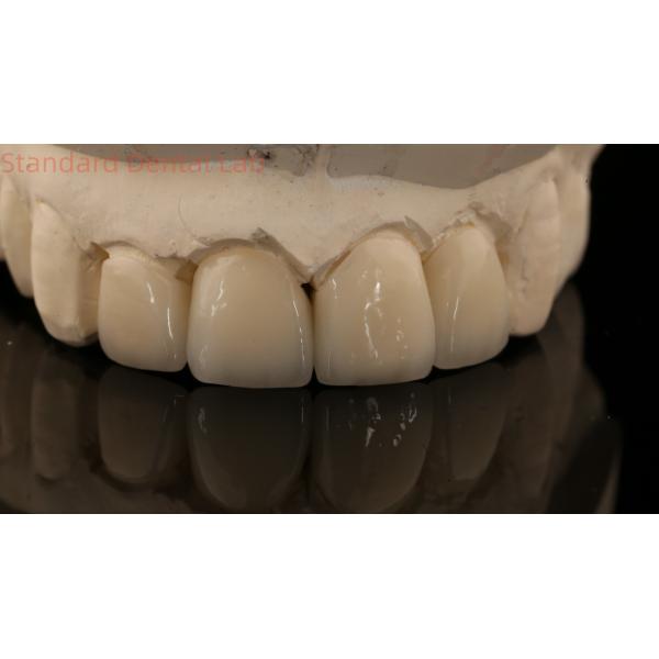 Strong Layered Zirconia Crown And Bridge In Good Esthetics Zirconia Layered China Dental Lab
