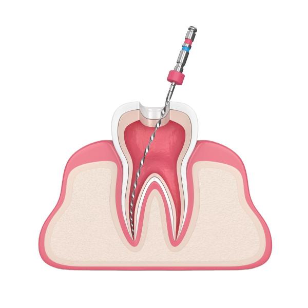 BS Blue Storm Rotary Root Canal Files Dental Endo Files