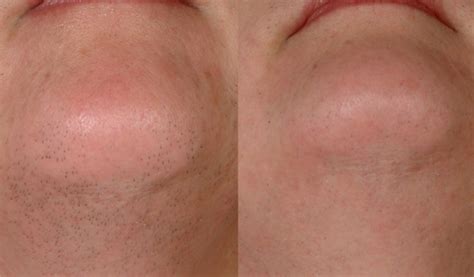 500W Portable 808nm Diode Laser Hair Removal Machine 810nm &  808nm 20ms - 400ms