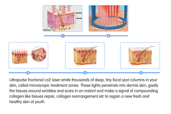 Pele que aperta a máquina 110V-250V do tratamento do laser do CO2