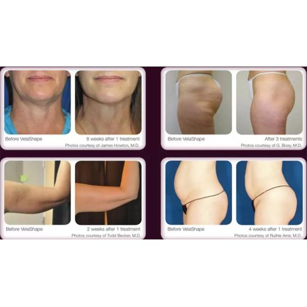 Rf Cavitation sous vide Body Slimming Machine de beauté Utilisation dans les salons