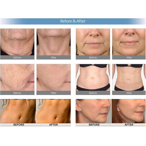 Multifunctional CO2 Fractional Laser Machine , Vaginal Tightening Equipment