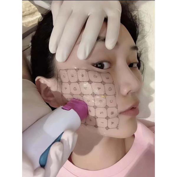 Машина 5Mhz радиочастоты подтяжки лица частичная microneedling