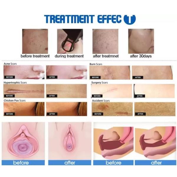 Лазер СО2 медицинской частичной длины волны контроля системы машины 10600нм красоты лазера частичный