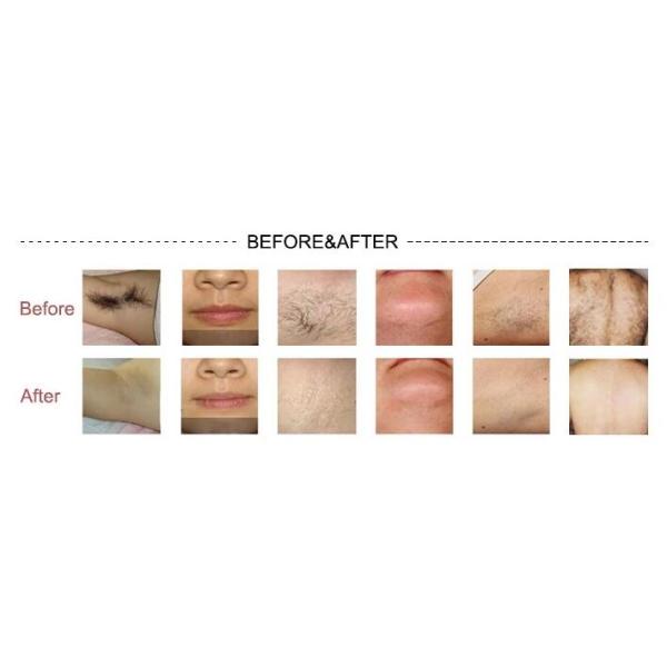 Vertical Pain Free Diode Hair Removal Laser Machine 808nm / 810nm Available