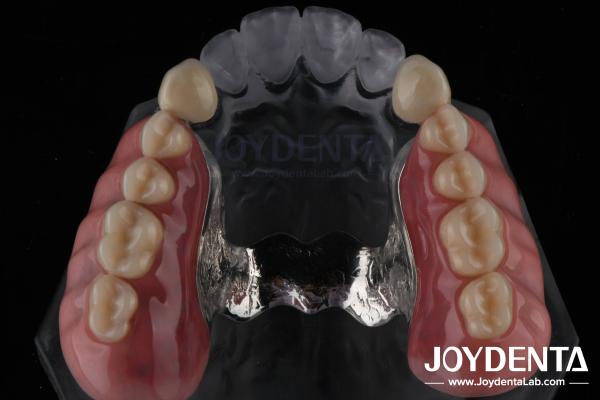 Precision Removable Prosthesis Dental Implant Attachments Easy Clean Comfortable Fit