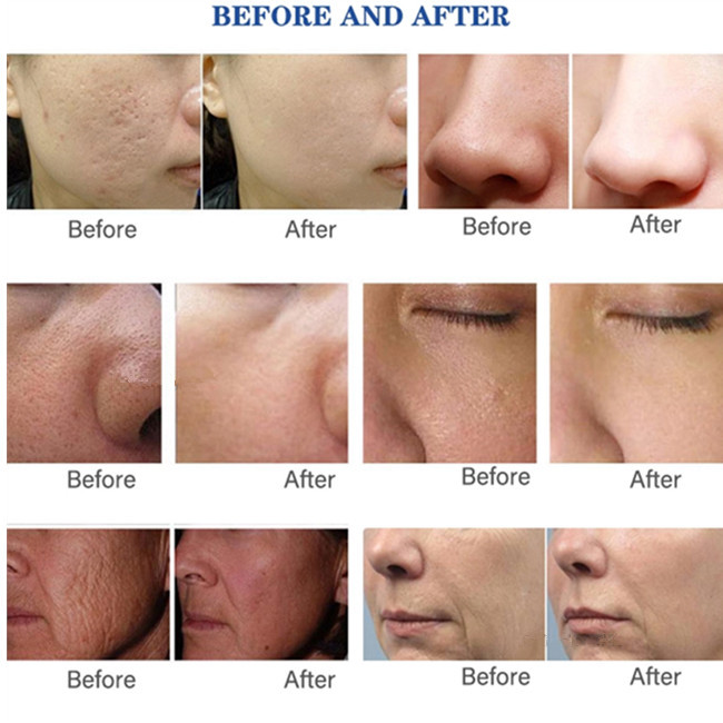 Оружие Hydrolifting машины оружия Mesotherapy отрицательного давления Meso