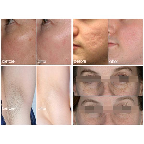 OPT SHR Epilation IPL Laser Hair Removal Machine 2000W 1-10Hz