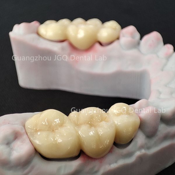 Perfect Looking Beautiful Zirconia Ceramic Crowns with Gum Lifelike China Dental Lab